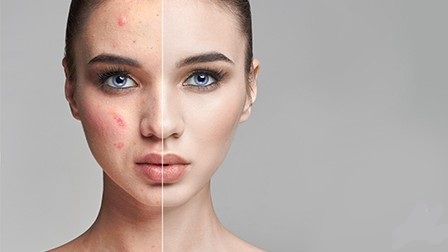 Биоревитализация или плазмотерапия что лучше. Смотреть фото Биоревитализация или плазмотерапия что лучше. Смотреть картинку Биоревитализация или плазмотерапия что лучше. Картинка про Биоревитализация или плазмотерапия что лучше. Фото Биоревитализация или плазмотерапия что лучше