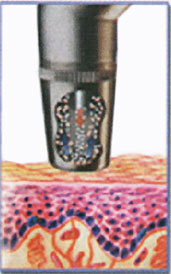 Микродермабразия - акваомоложение. Трансэпидермальное введение